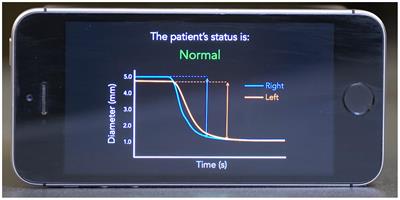 Mobile Smartphone-Based Digital Pupillometry Curves in the Diagnosis of Traumatic Brain Injury